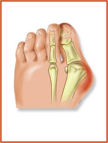 What is a Bunion? – Santi Podiatry Group